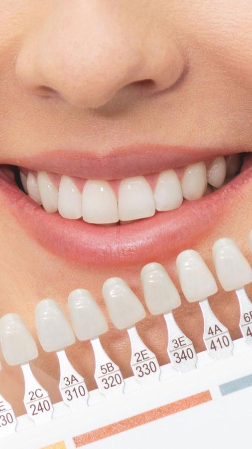 Mockup photo — dentist matching a veneer shade against a smile