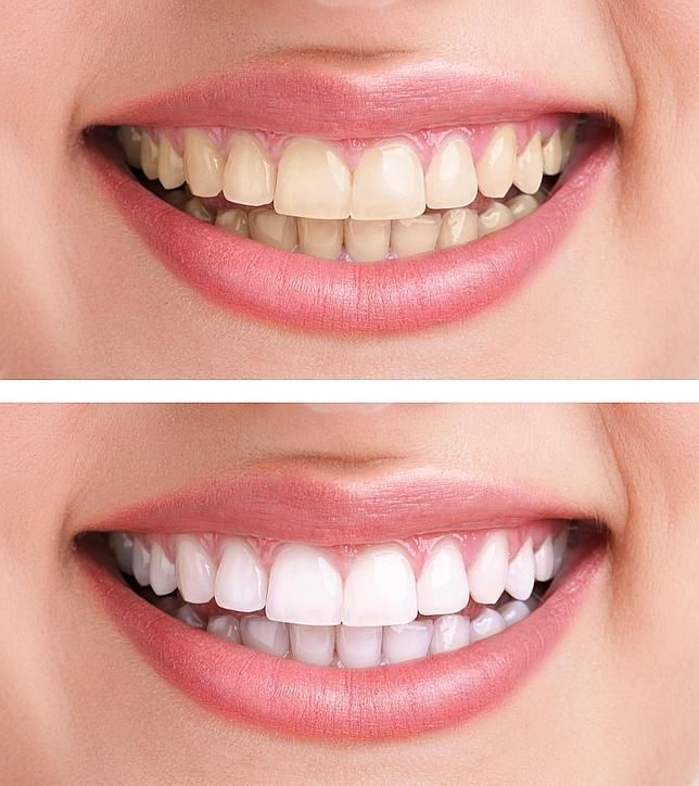 Mockup photo — teeth whitening before and after comparison